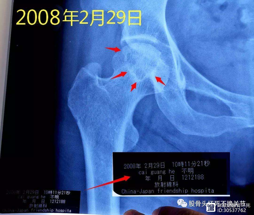 马鞍山人工骨头医保报销多少(人工骨头医保报销多少比例)